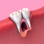 Qué es un alveolo dental