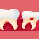 Qué es la pericoronaritis